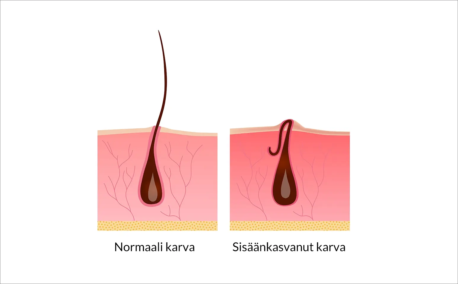 Normaali karva vs Sisäänkasvanut karva